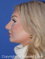 Caucasian/European Rhinoplasty - Case 93 - Before
