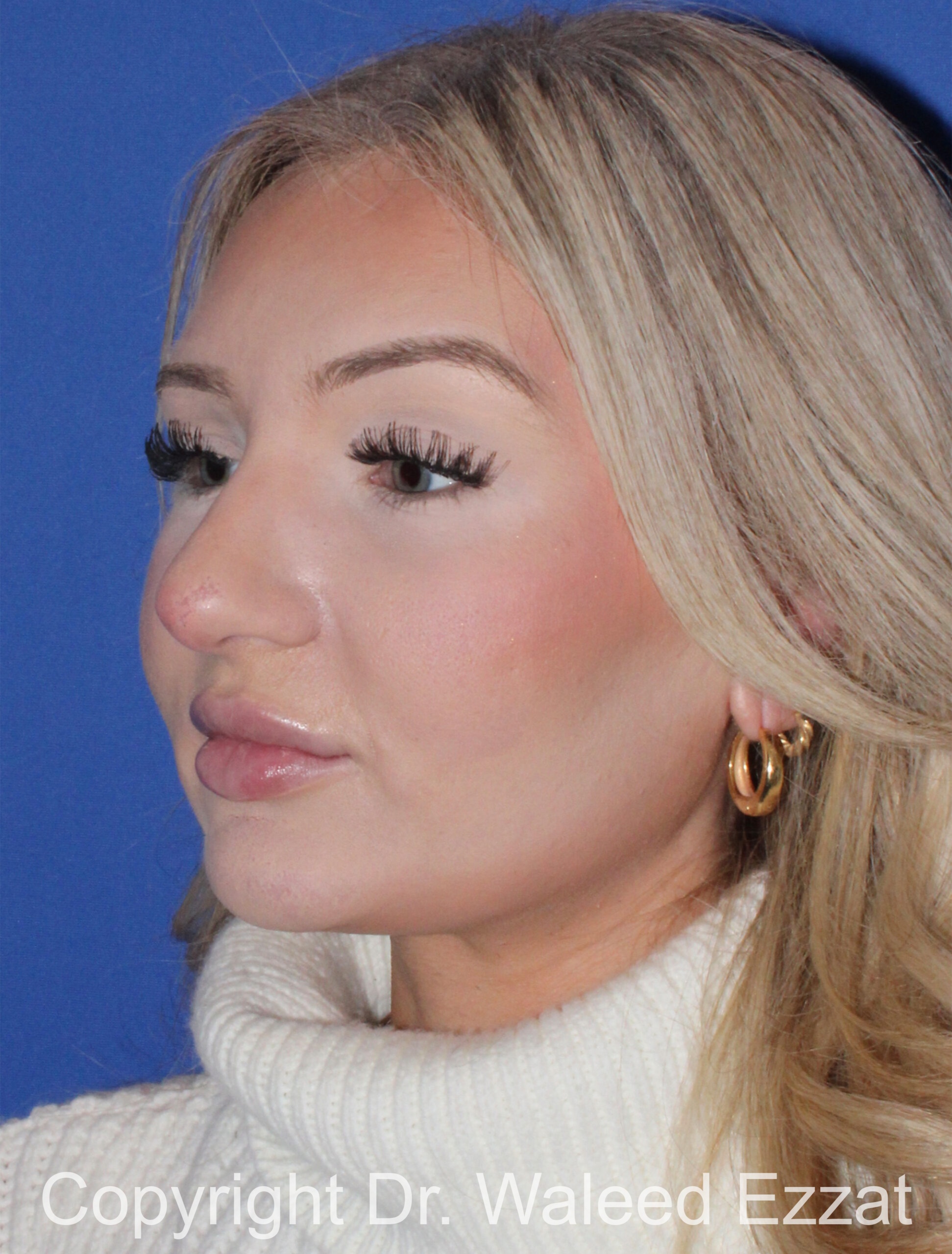 Rhinoplasty Patient Photo - Case 93 - before view-1