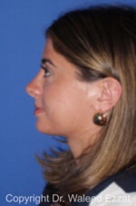 Caucasian/European Rhinoplasty - Case 94 - After