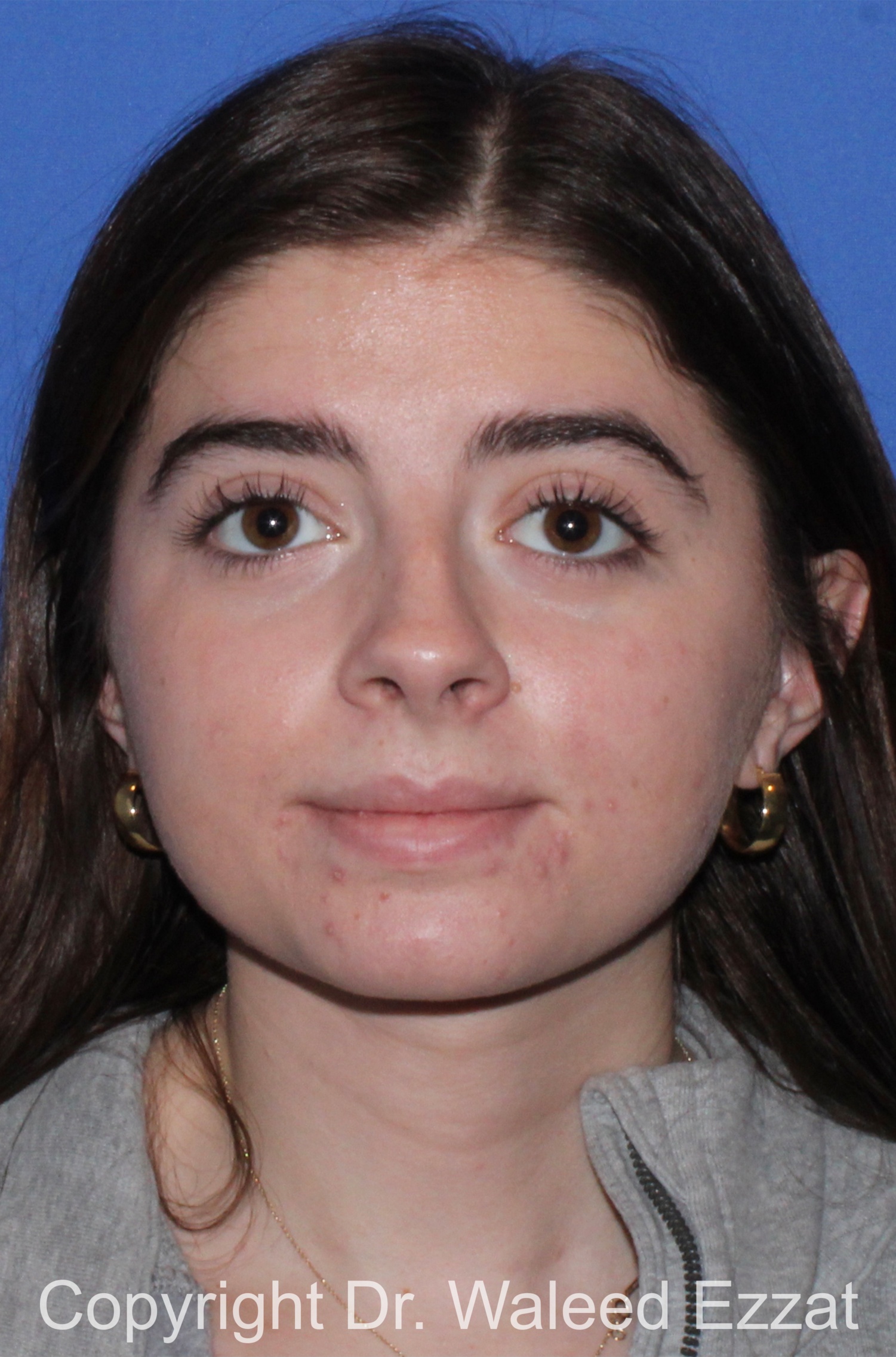 Caucasian/European Rhinoplasty Patient Photo - Case 94 - before view-2