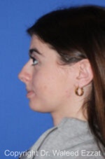 Caucasian/European Rhinoplasty - Case 94 - Before