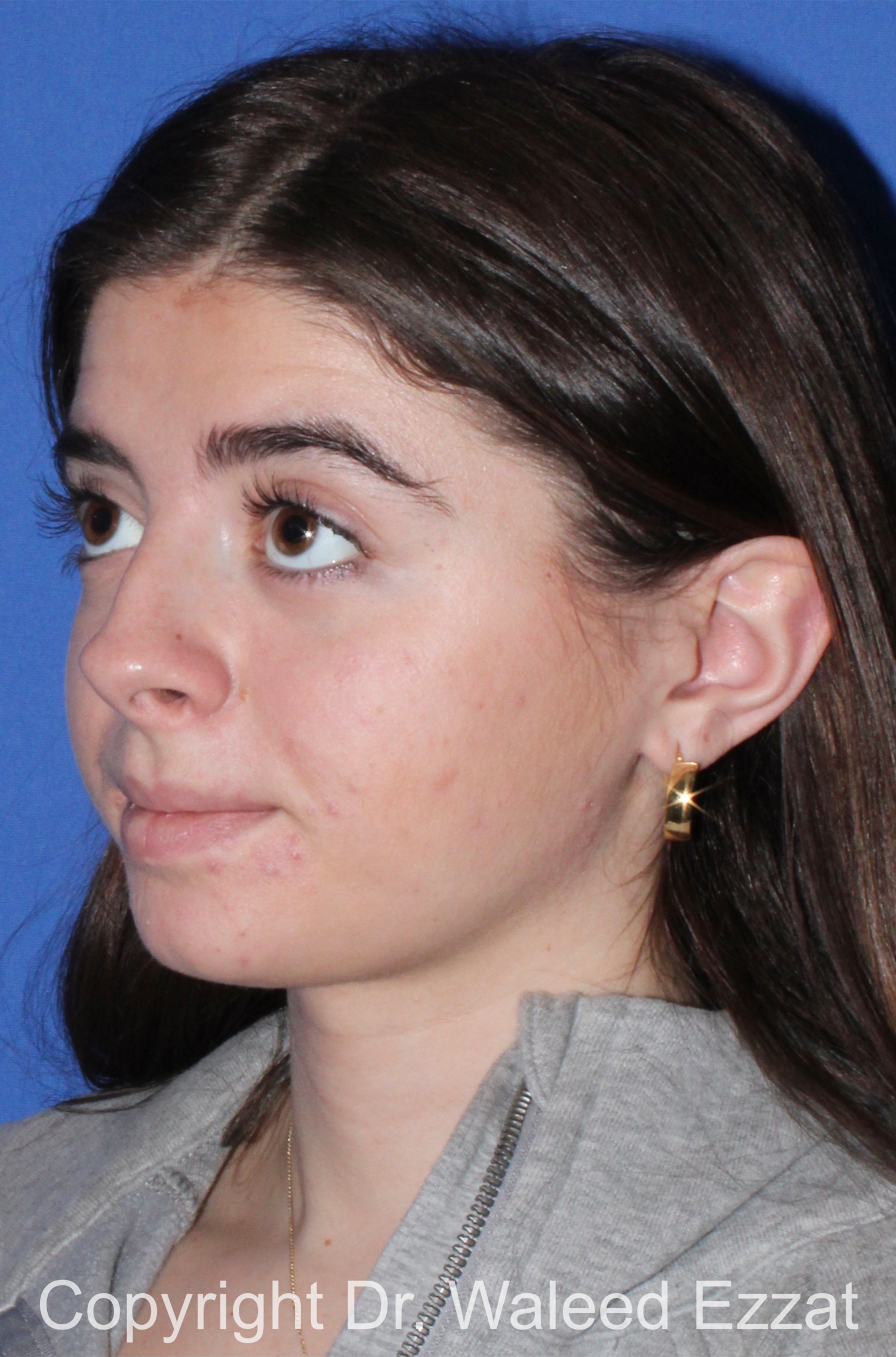 Caucasian/European Rhinoplasty Patient Photo - Case 94 - before view-1