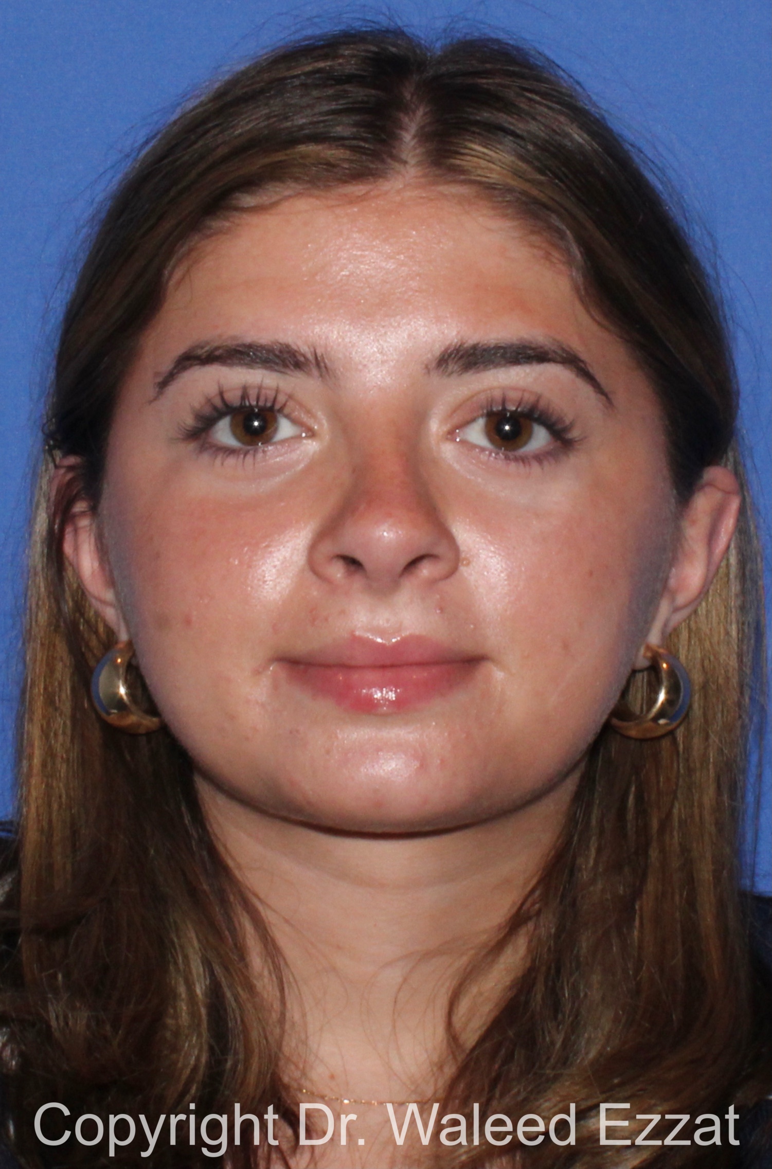 Caucasian/European Rhinoplasty Patient Photo - Case 94 - after view-2