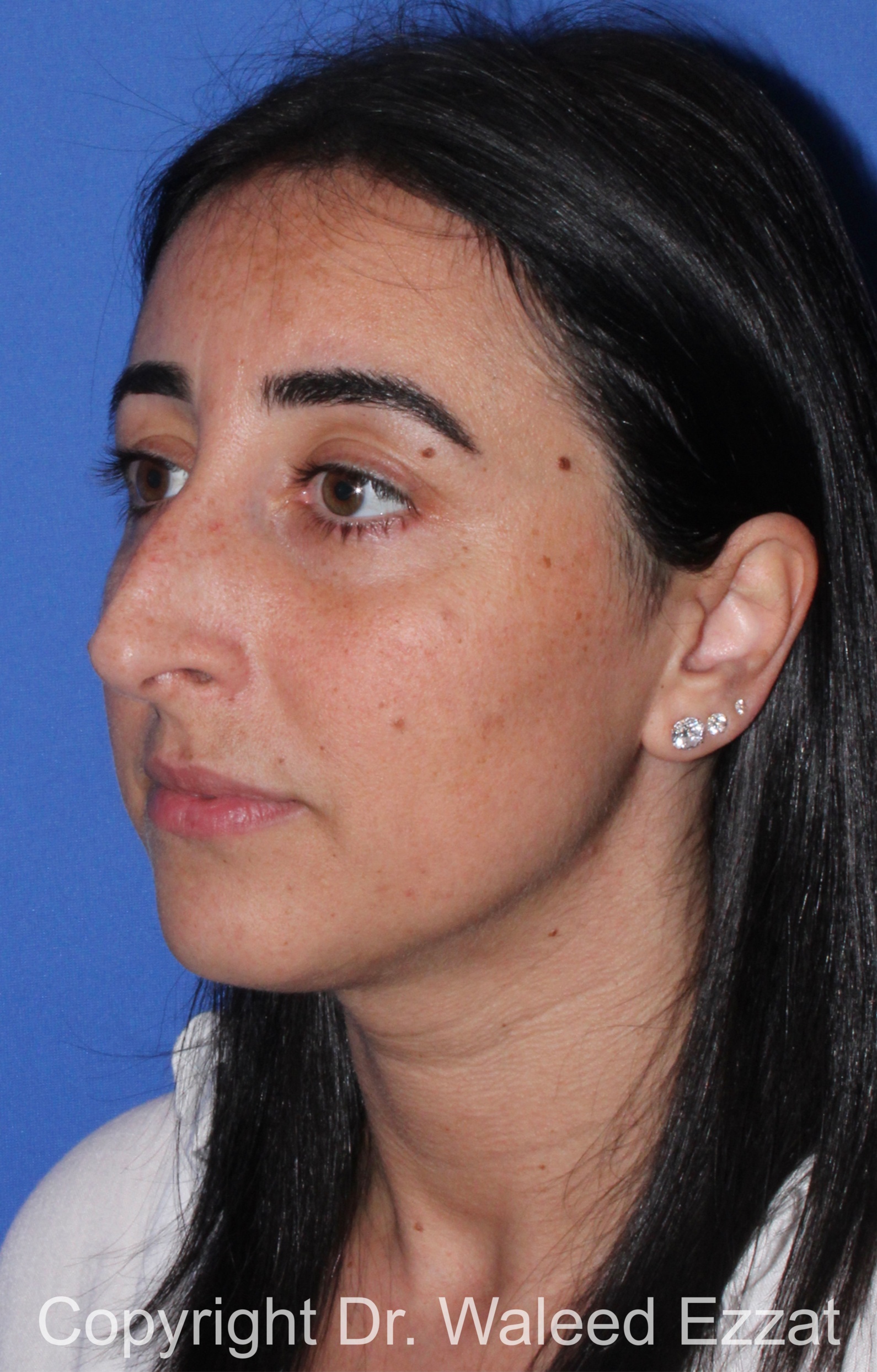 Caucasian/European Rhinoplasty Patient Photo - Case 95 - before view-1