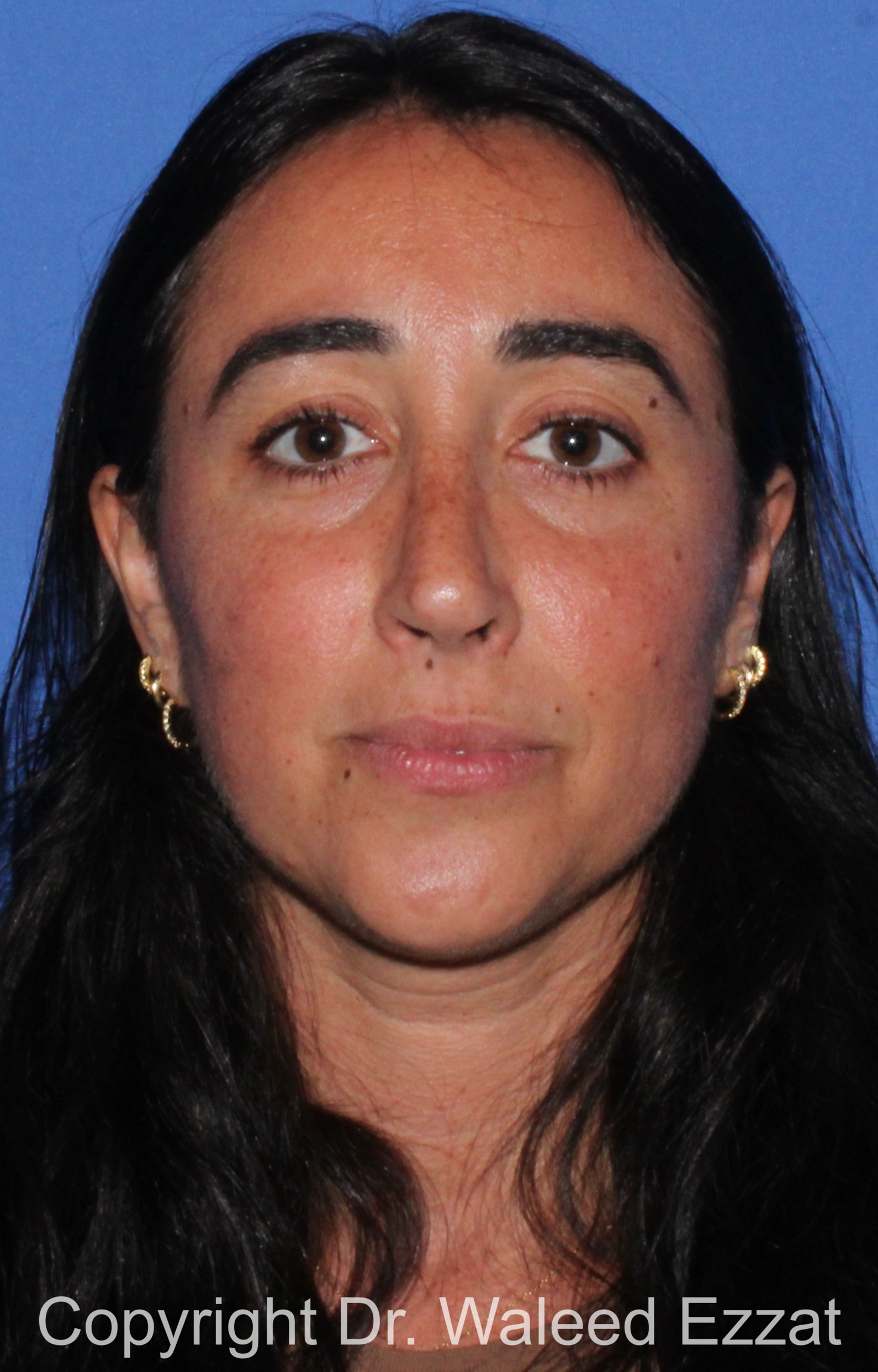 Caucasian/European Rhinoplasty Patient Photo - Case 95 - after view-2