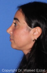 Caucasian/European Rhinoplasty - Case 95 - After