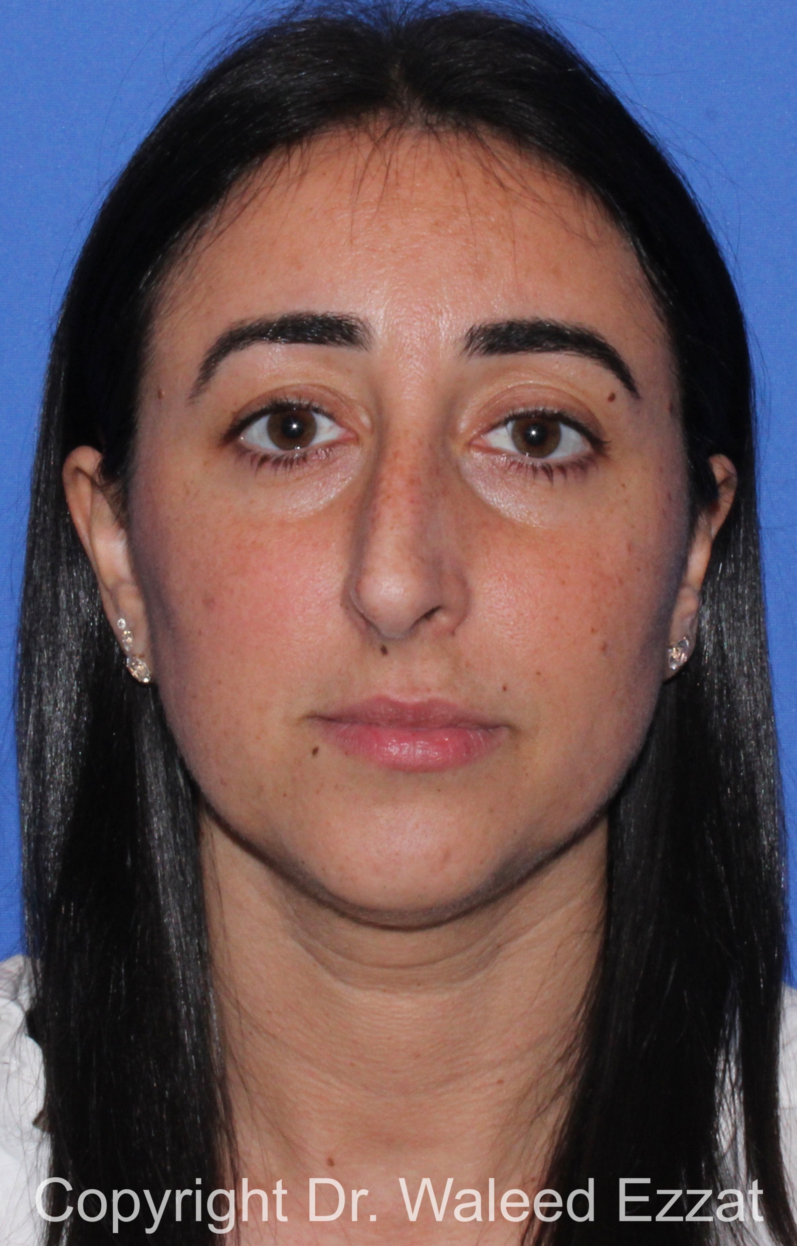 Caucasian/European Rhinoplasty Patient Photo - Case 95 - before view-2