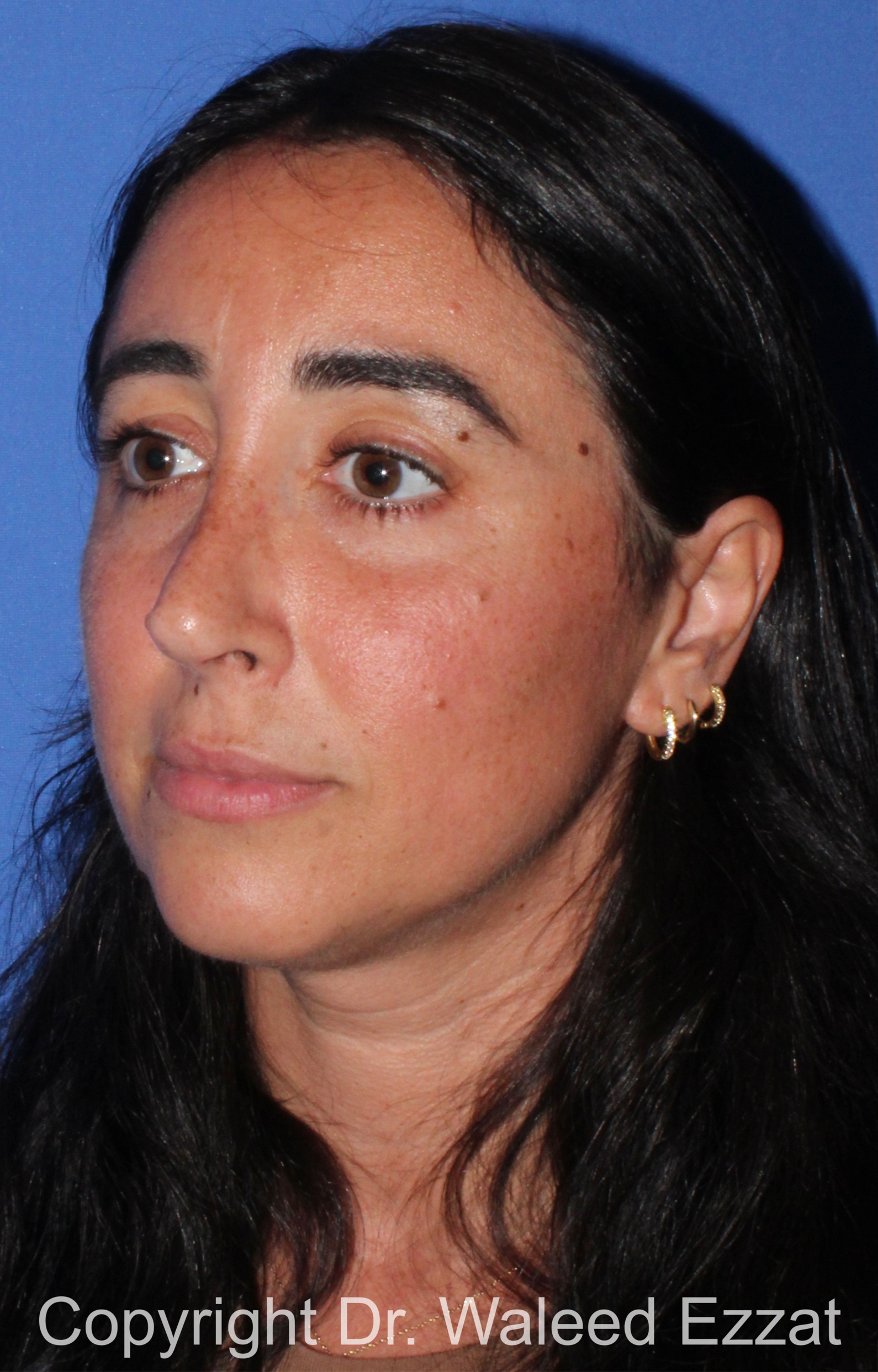 Caucasian/European Rhinoplasty Patient Photo - Case 95 - after view-1