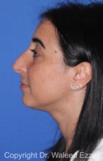 Caucasian/European Rhinoplasty - Case 95 - Before