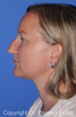 Caucasian/European Rhinoplasty - Case 97 - Before