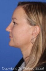 Caucasian/European Rhinoplasty - Case 97 - After