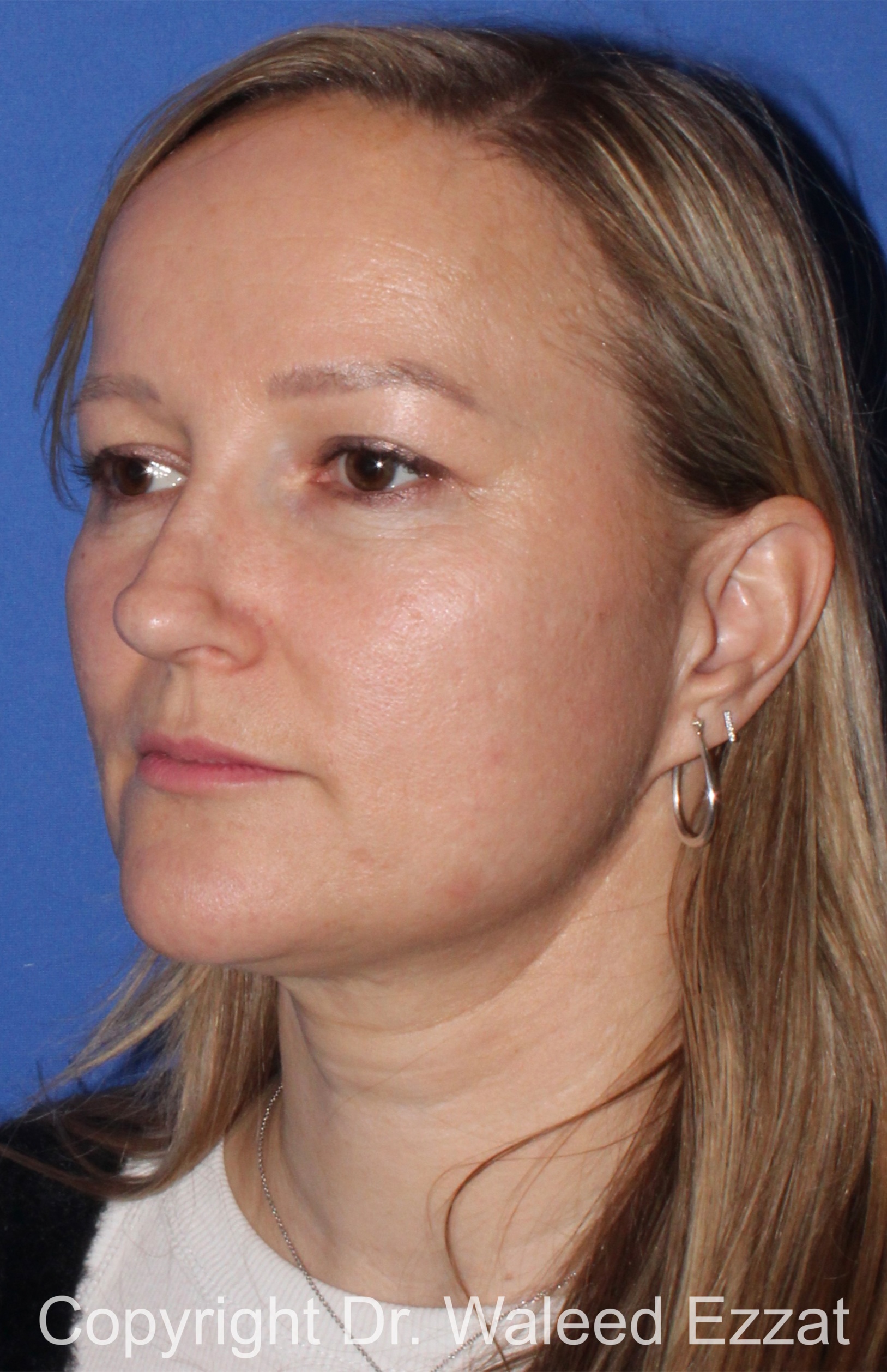 Caucasian/European Rhinoplasty Patient Photo - Case 97 - after view-1