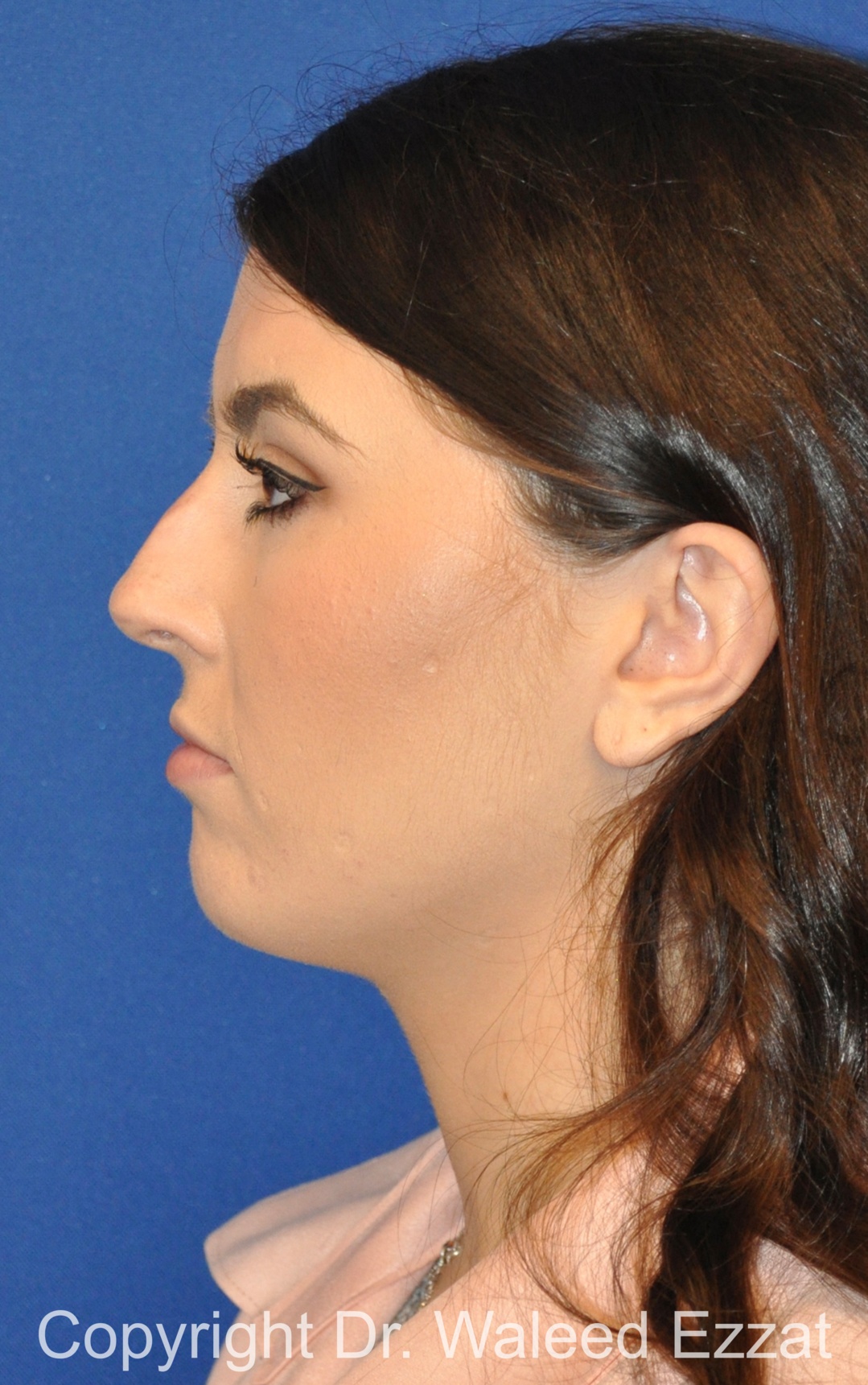 Caucasian/European Rhinoplasty Patient Photo - Case 98 - before view-