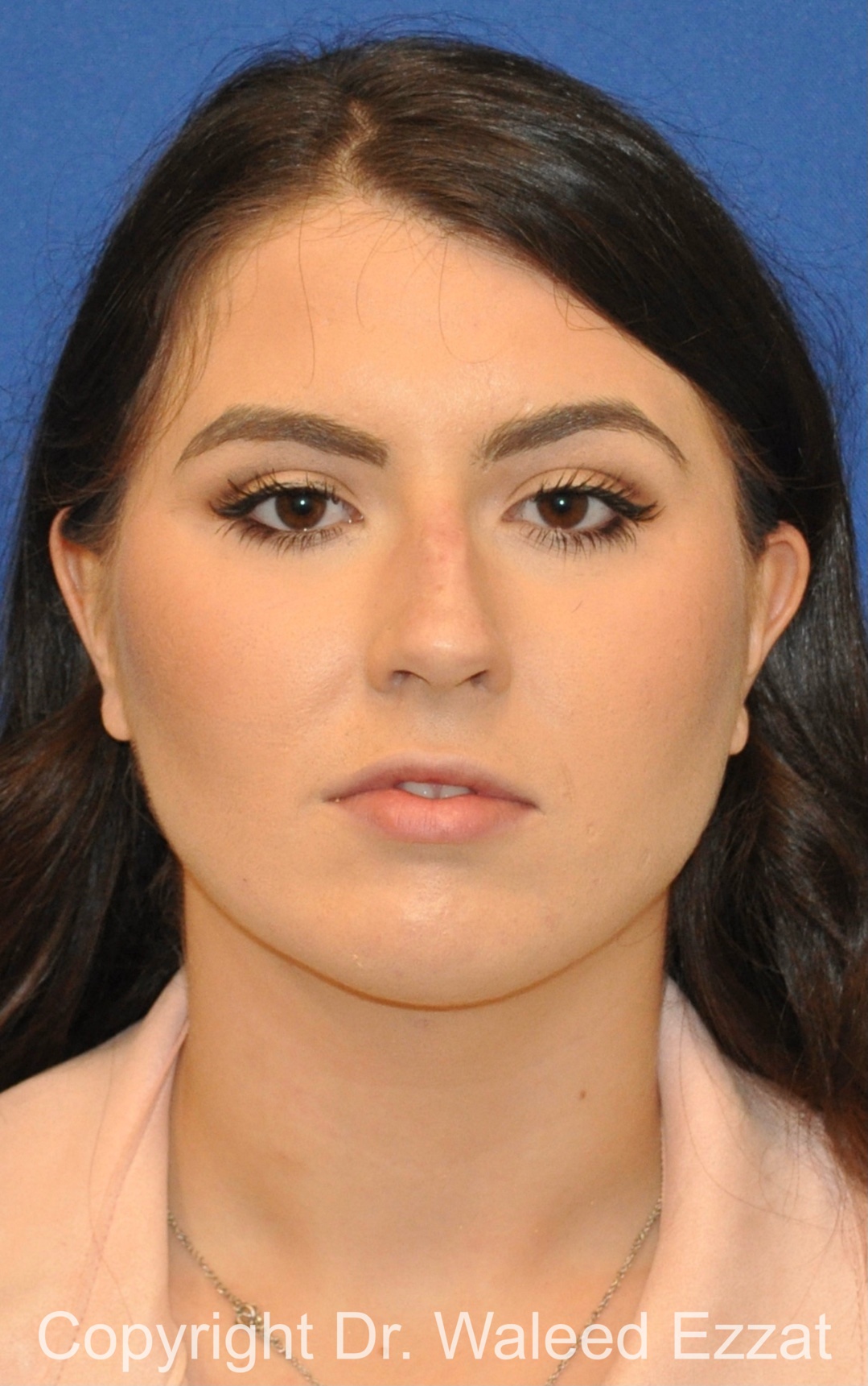 Caucasian/European Rhinoplasty Patient Photo - Case 98 - before view-2