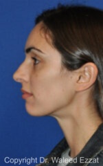 Caucasian/European Rhinoplasty - Case 330 - Before