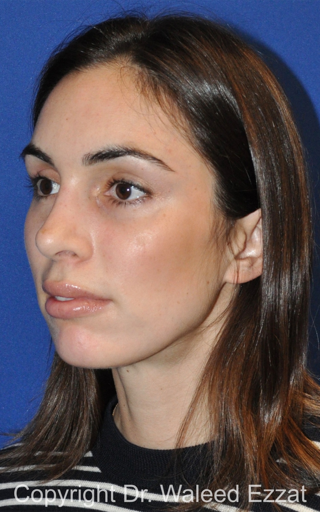 Caucasian/European Rhinoplasty Patient Photo - Case 330 - after view-1