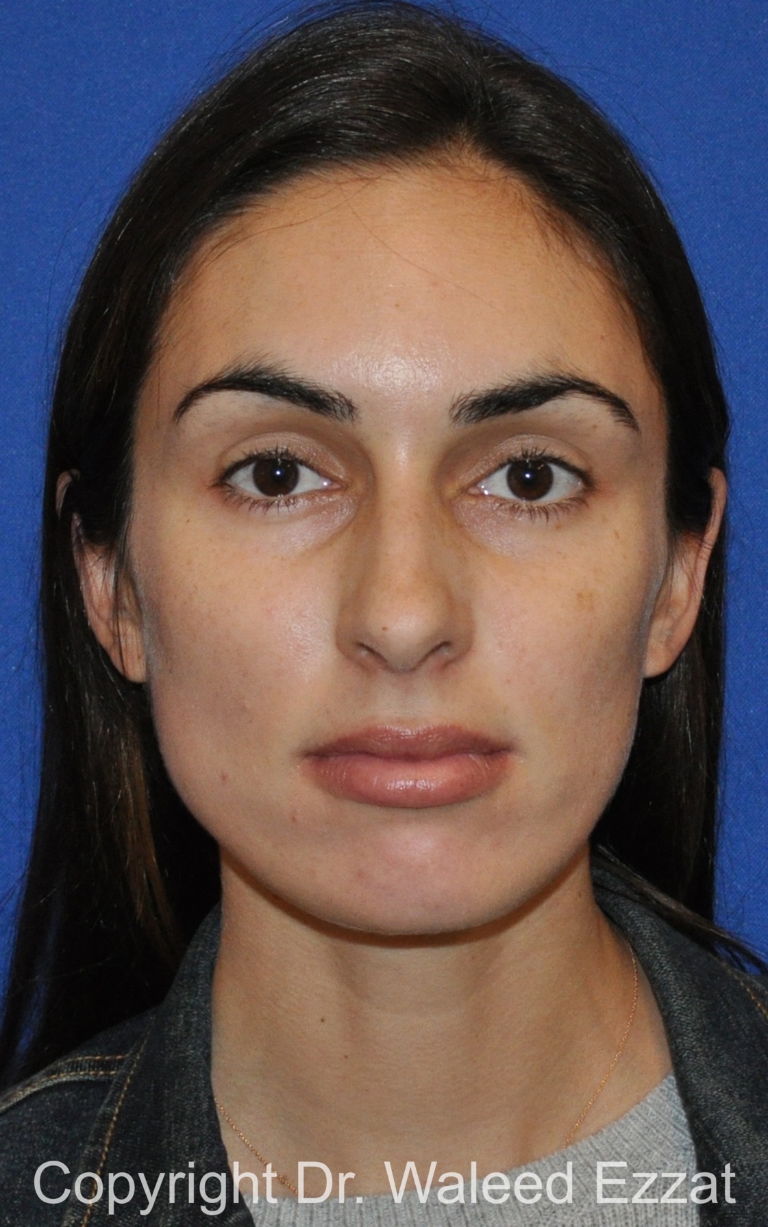 Caucasian/European Rhinoplasty Patient Photo - Case 330 - before view-2