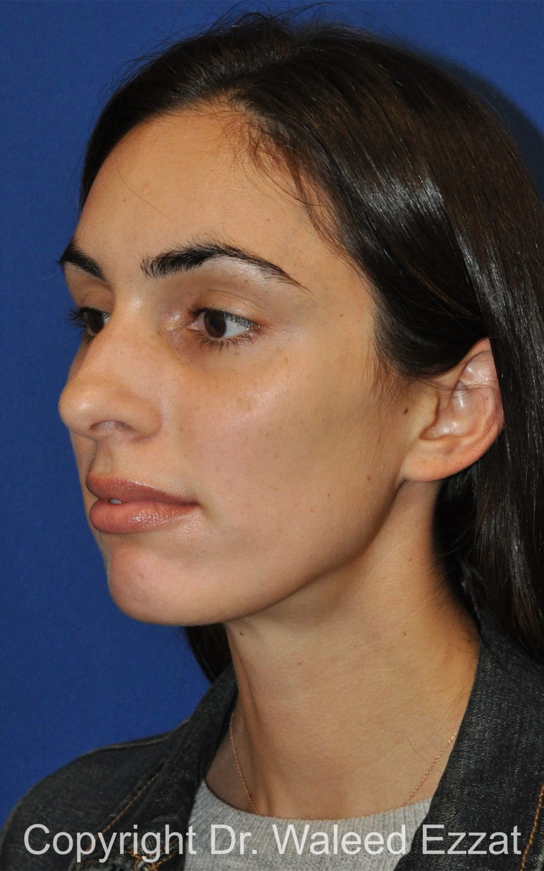 Caucasian/European Rhinoplasty Patient Photo - Case 330 - before view-1