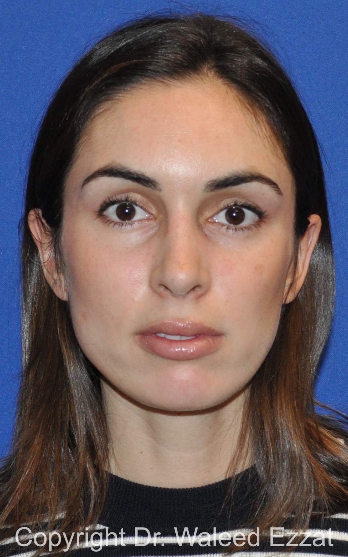 Caucasian/European Rhinoplasty Patient Photo - Case 330 - after view-2