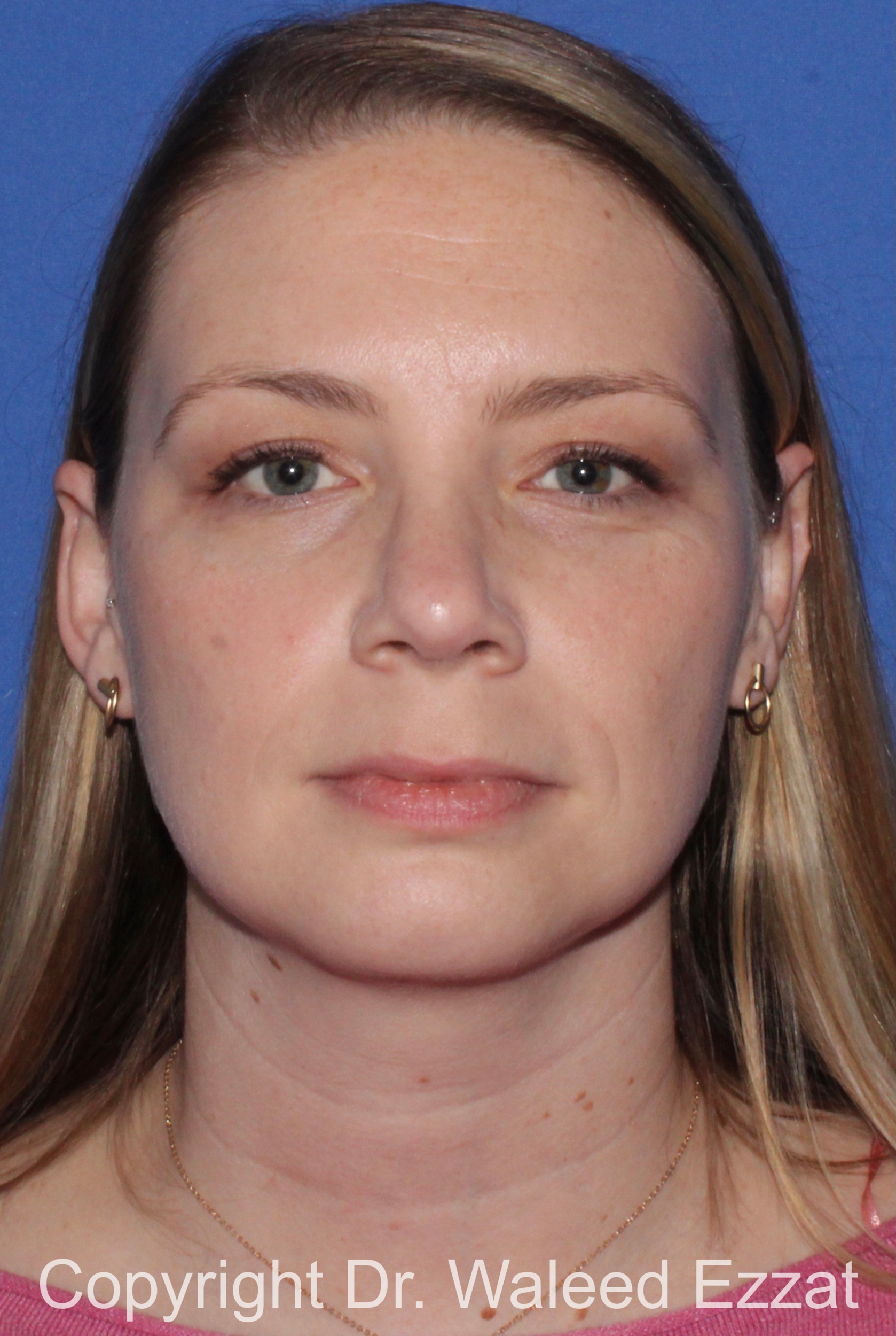 Rhinoplasty Patient Photo - Case 331 - after view-2