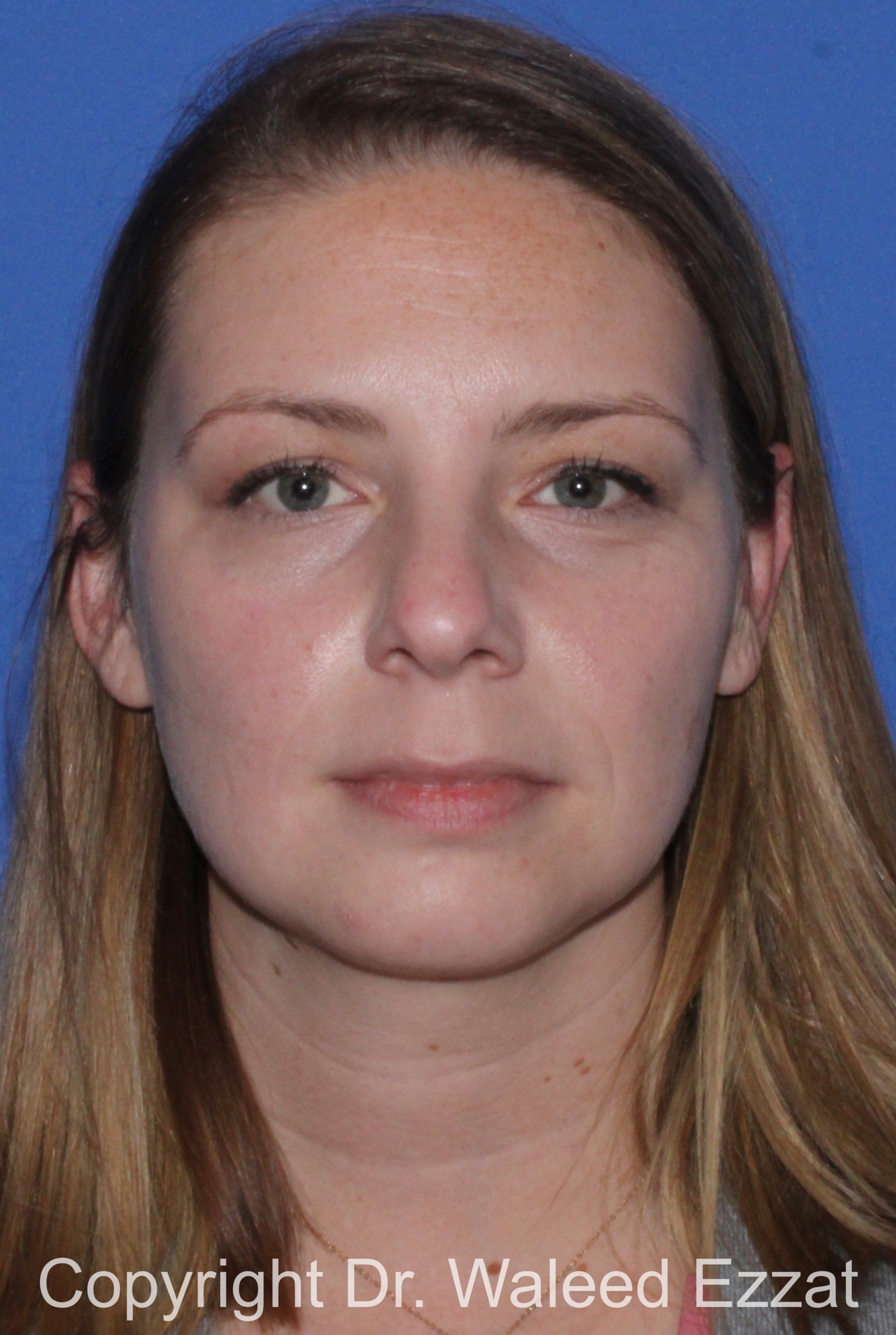 Rhinoplasty Patient Photo - Case 331 - before view-2