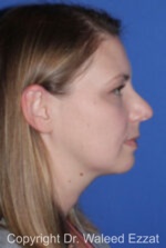 Caucasian/European Rhinoplasty - Case 331 - Before