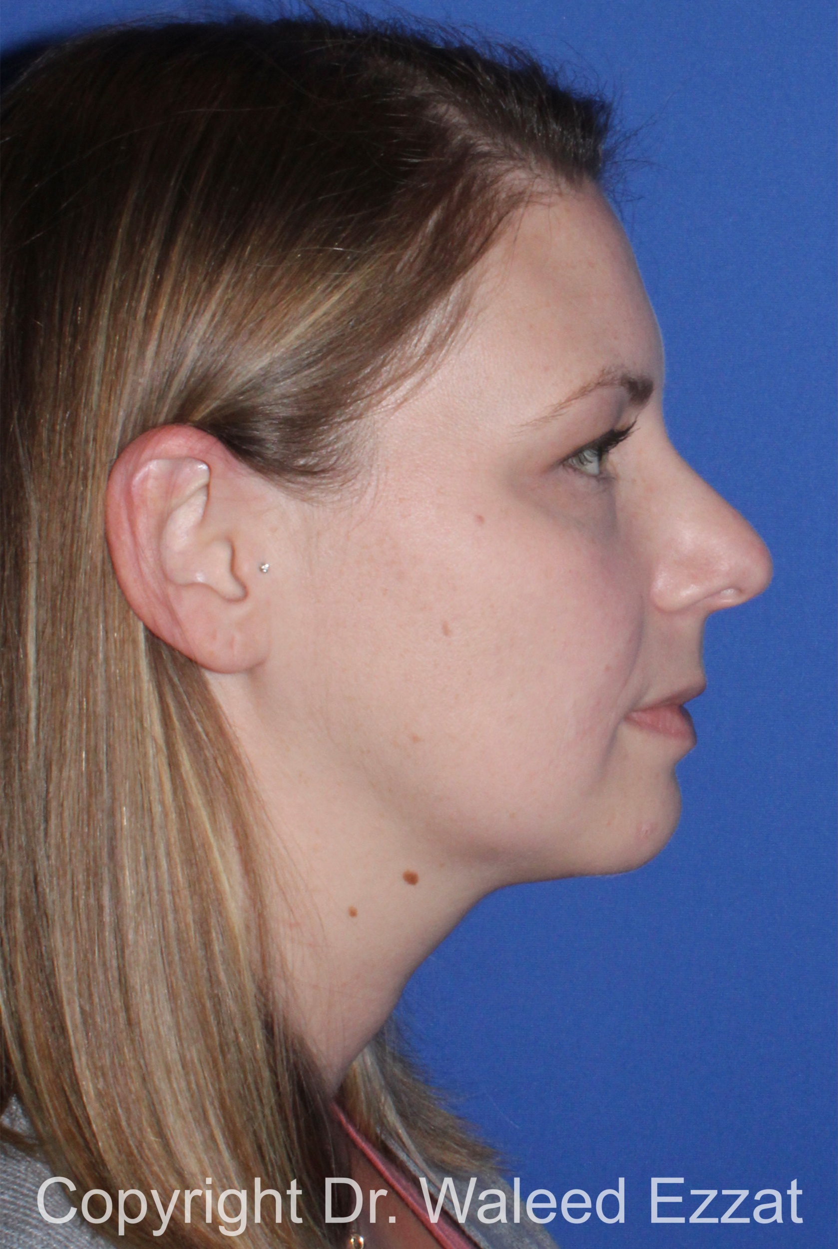 Rhinoplasty Patient Photo - Case 331 - before view-