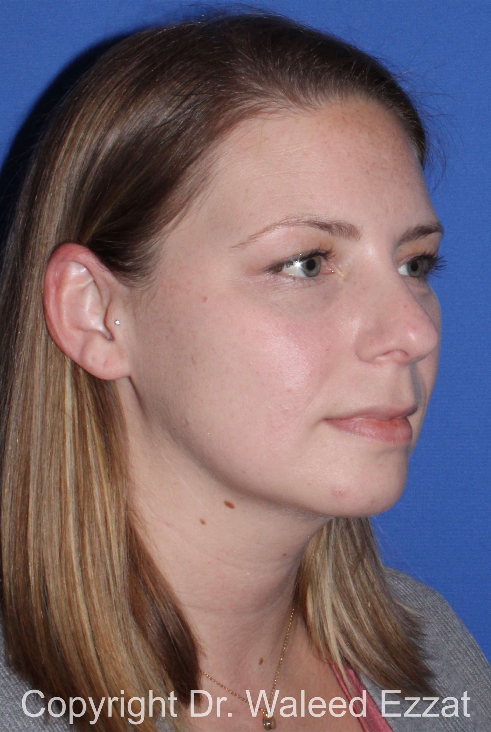 Rhinoplasty Patient Photo - Case 331 - before view-1