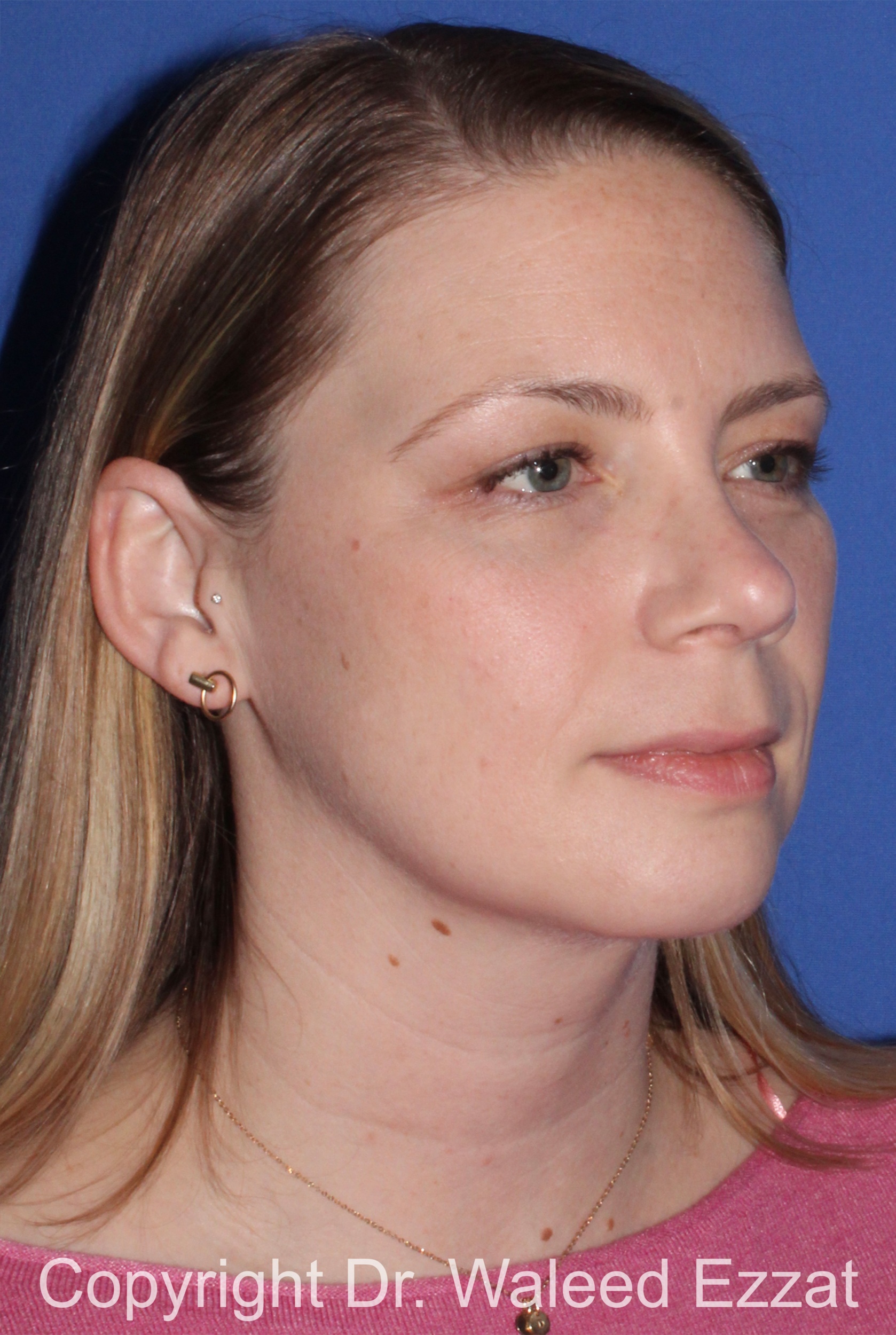 Rhinoplasty Patient Photo - Case 331 - after view-1