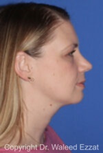 Caucasian/European Rhinoplasty - Case 331 - After