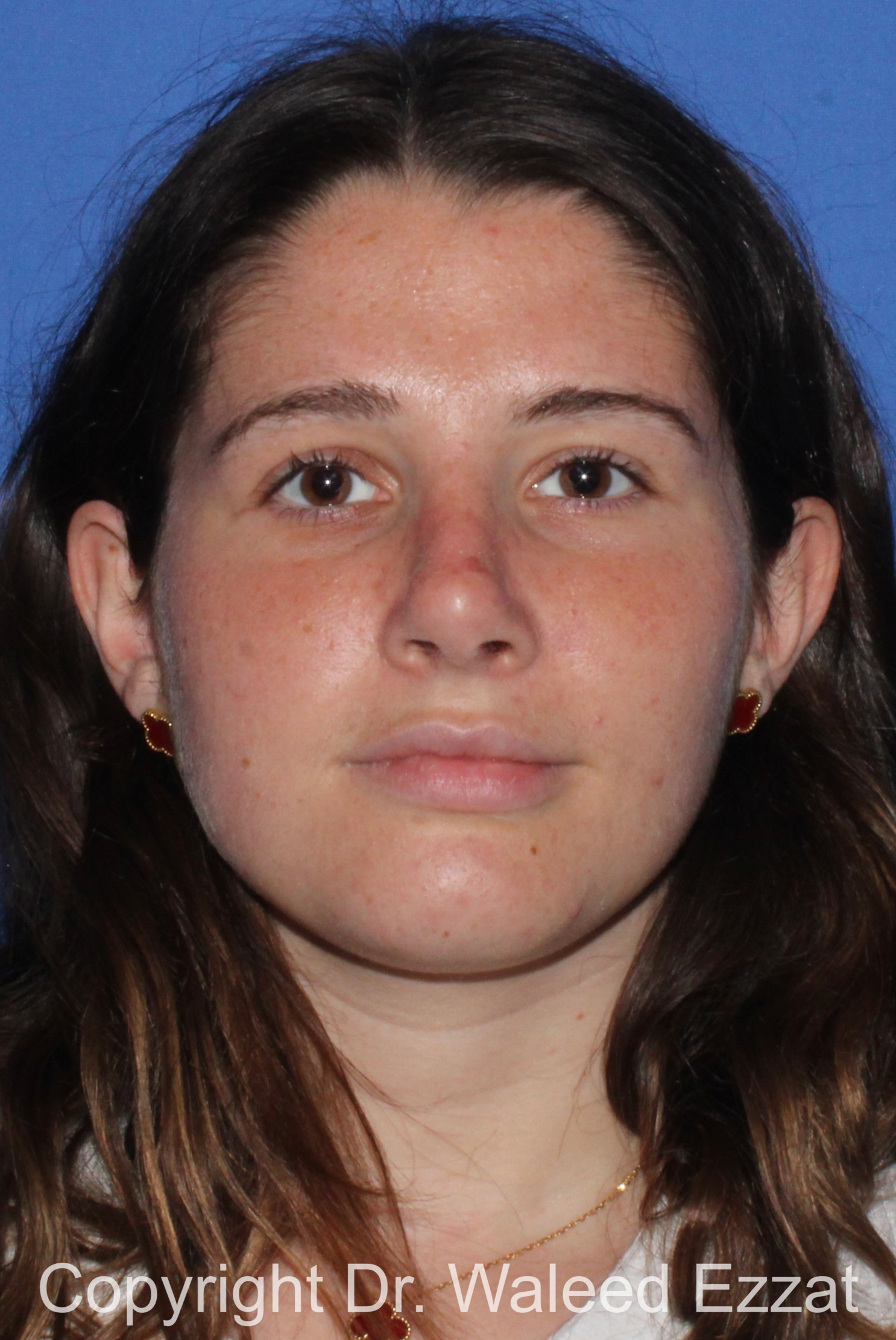 Caucasian/European Rhinoplasty Patient Photo - Case 333 - after view-2