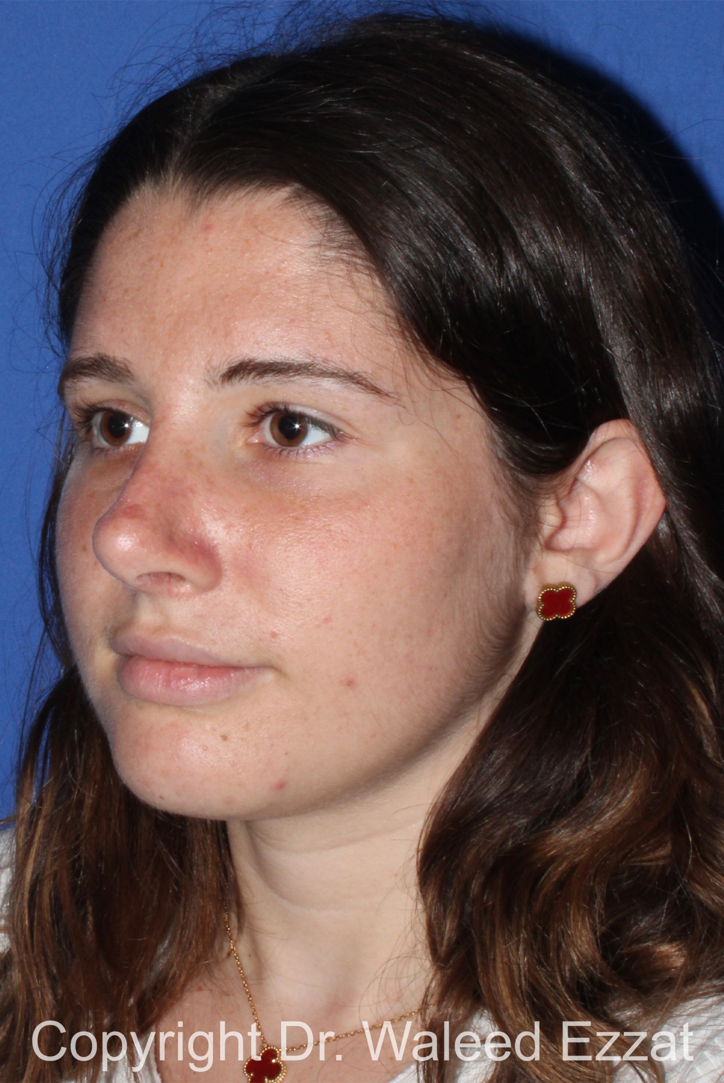 Caucasian/European Rhinoplasty Patient Photo - Case 333 - after view-1