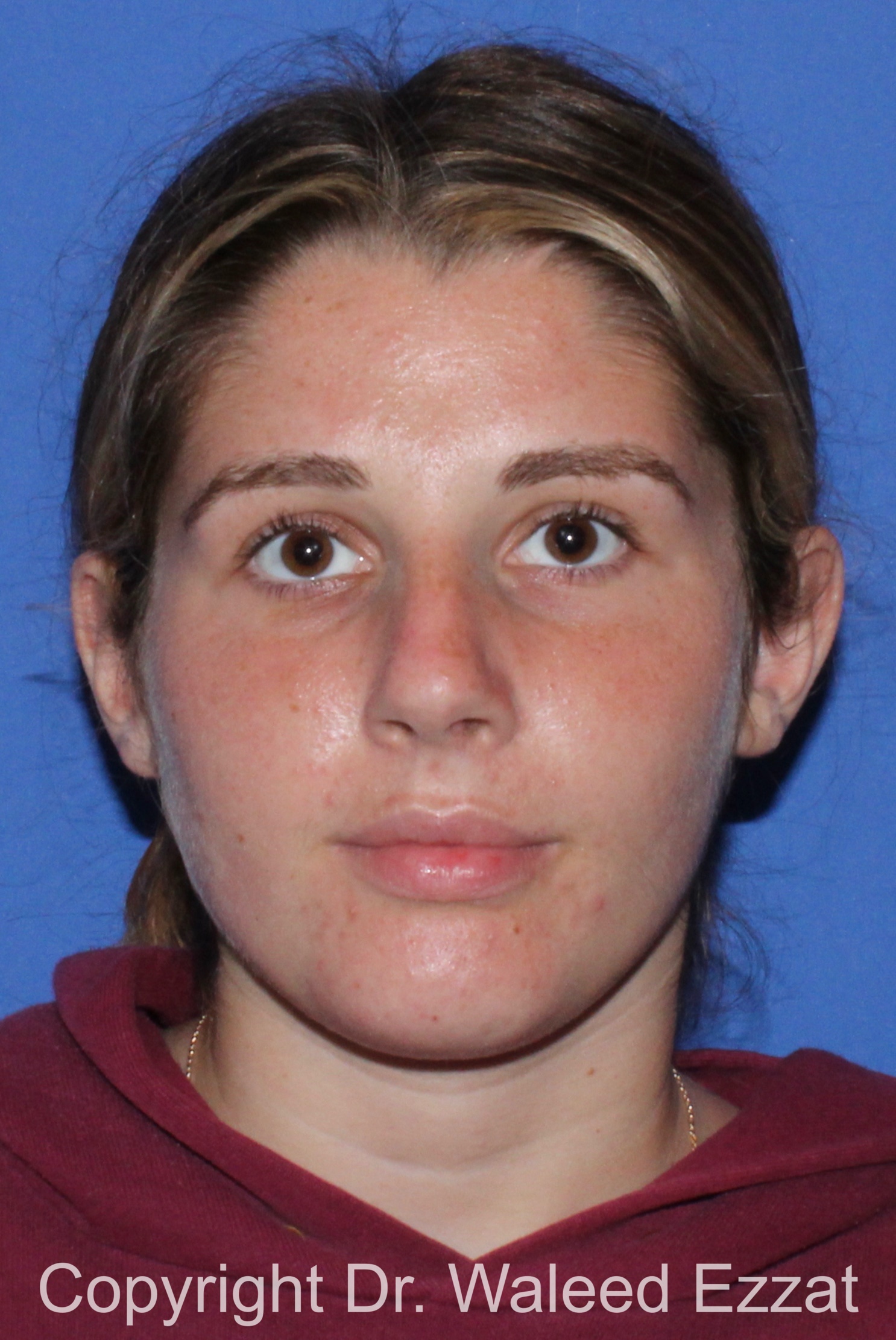 Caucasian/European Rhinoplasty Patient Photo - Case 333 - before view-2