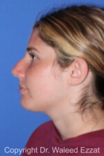 Caucasian/European Rhinoplasty - Case 333 - Before