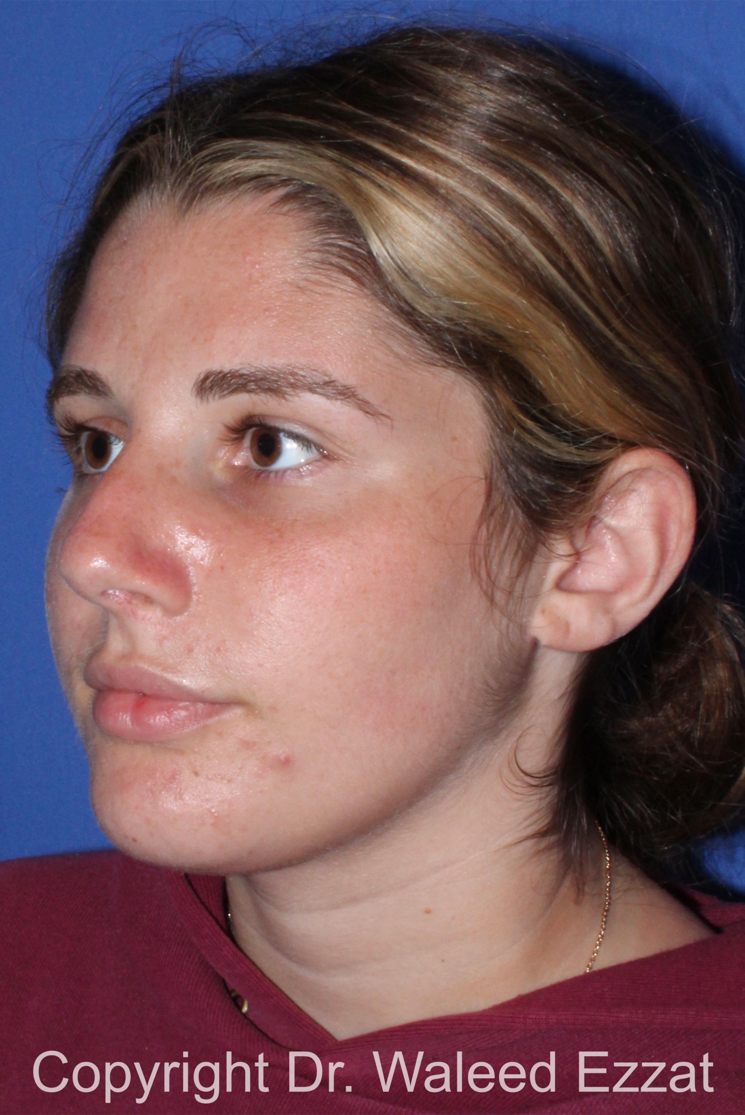 Caucasian/European Rhinoplasty Patient Photo - Case 333 - before view-1