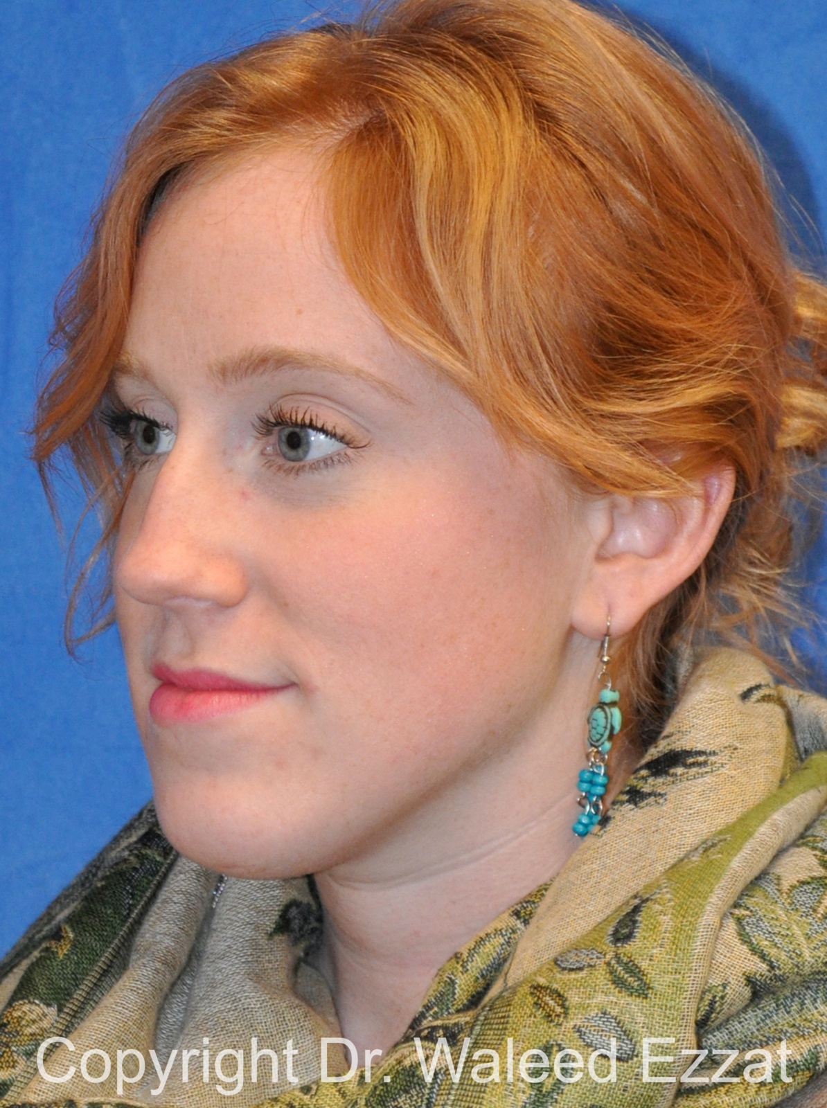 Caucasian/European Rhinoplasty Patient Photo - Case 334 - before view-1