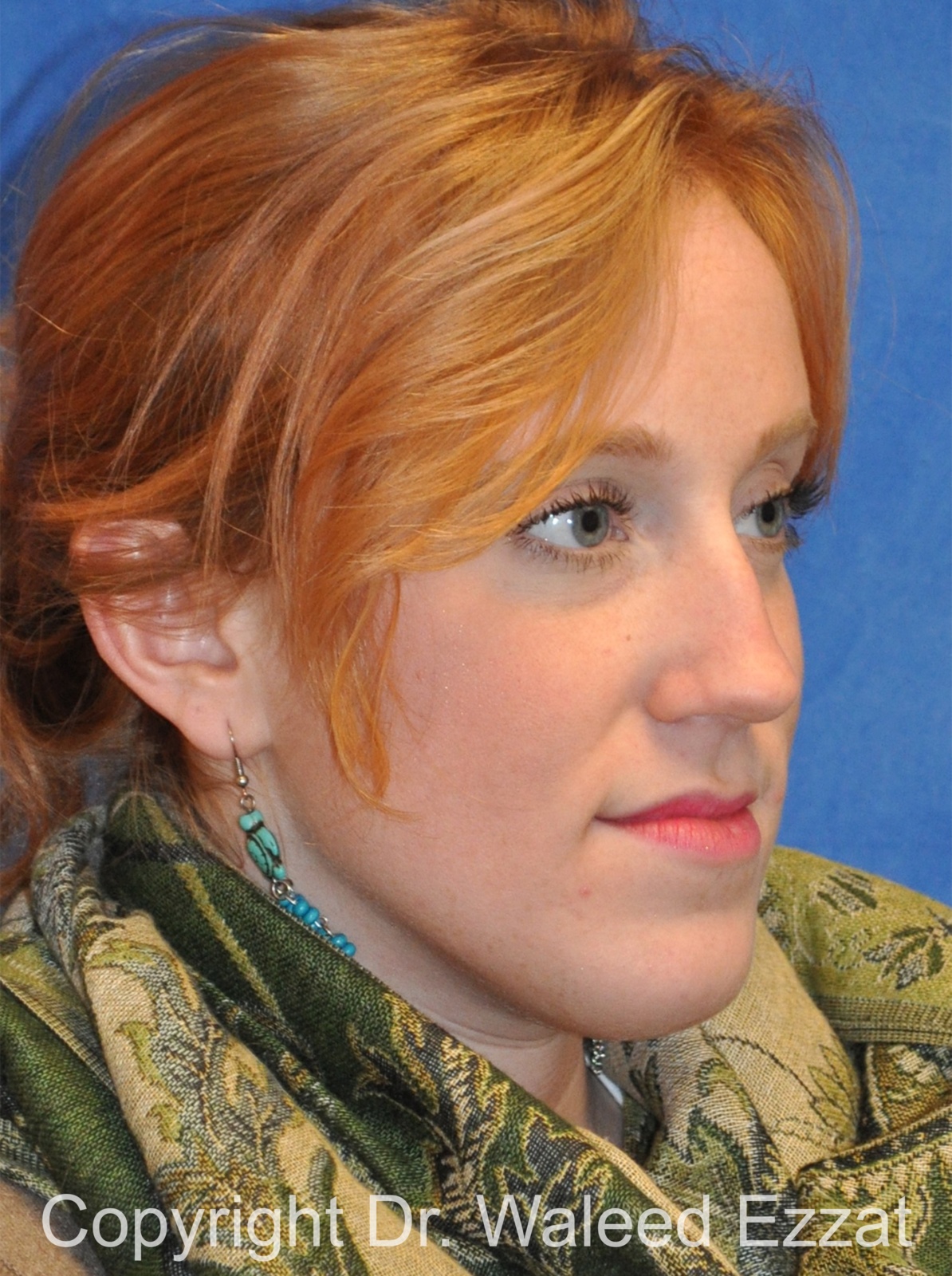 Caucasian/European Rhinoplasty Patient Photo - Case 334 - before view-3