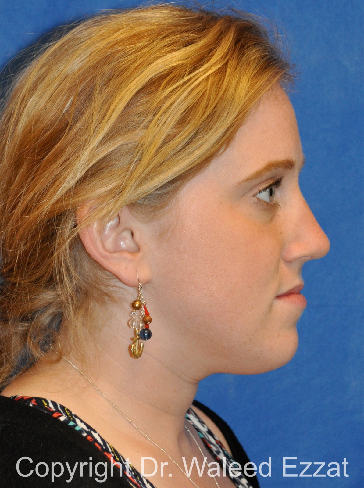 Caucasian/European Rhinoplasty Patient Photo - Case 334 - after view-2
