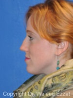 Caucasian/European Rhinoplasty - Case 334 - Before