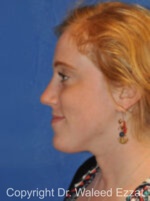 Caucasian/European Rhinoplasty - Case 334 - After