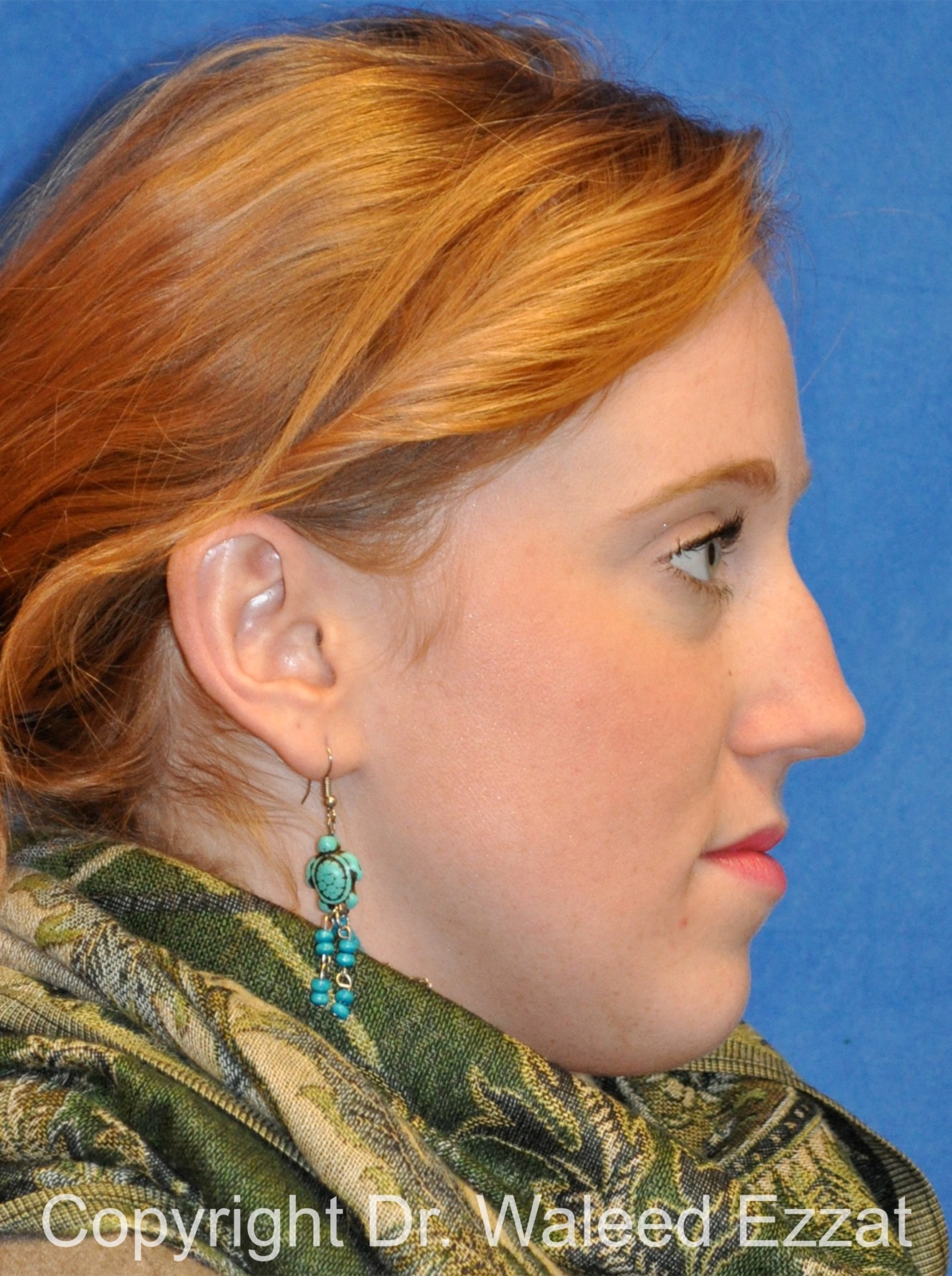 Caucasian/European Rhinoplasty Patient Photo - Case 334 - before view-2