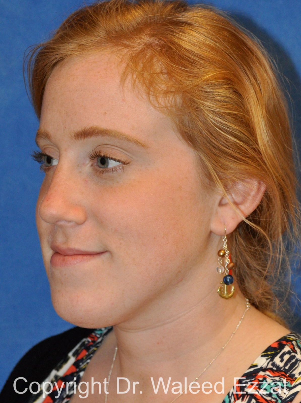 Caucasian/European Rhinoplasty Patient Photo - Case 334 - after view-1