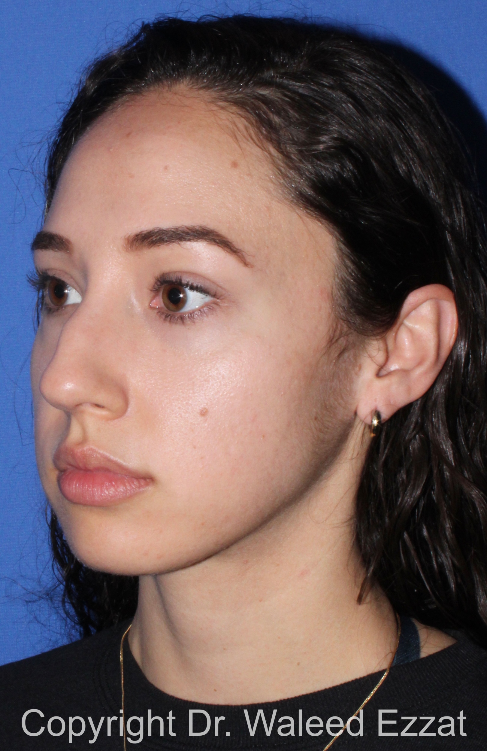 Caucasian/European Rhinoplasty Patient Photo - Case 335 - before view-1