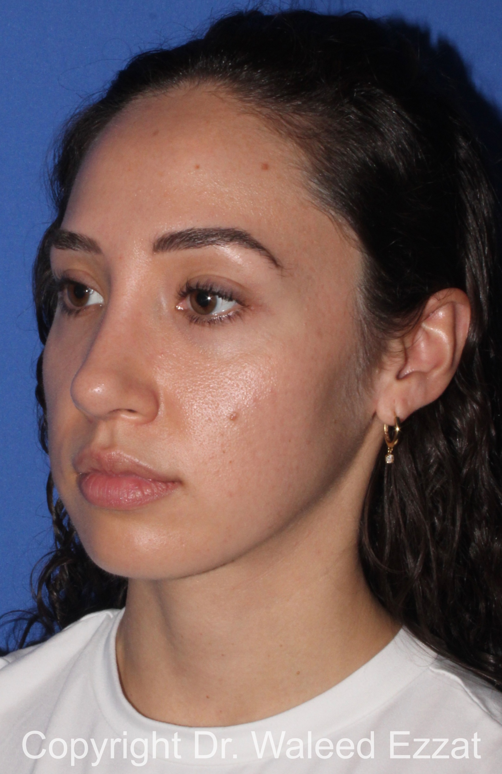 Caucasian/European Rhinoplasty Patient Photo - Case 335 - after view-1