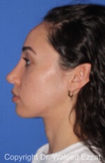 Caucasian/European Rhinoplasty - Case 335 - After