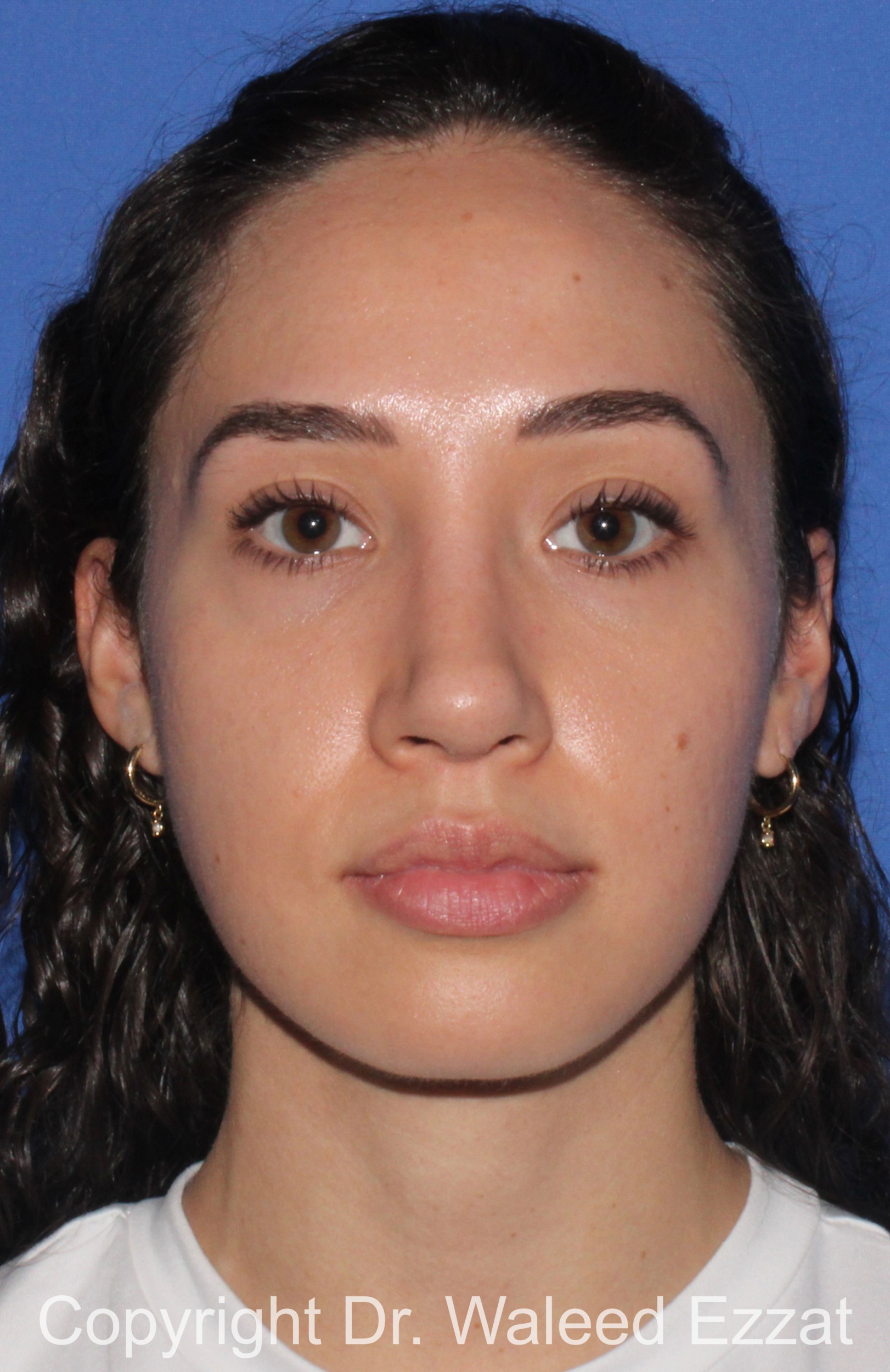 Caucasian/European Rhinoplasty Patient Photo - Case 335 - after view-2