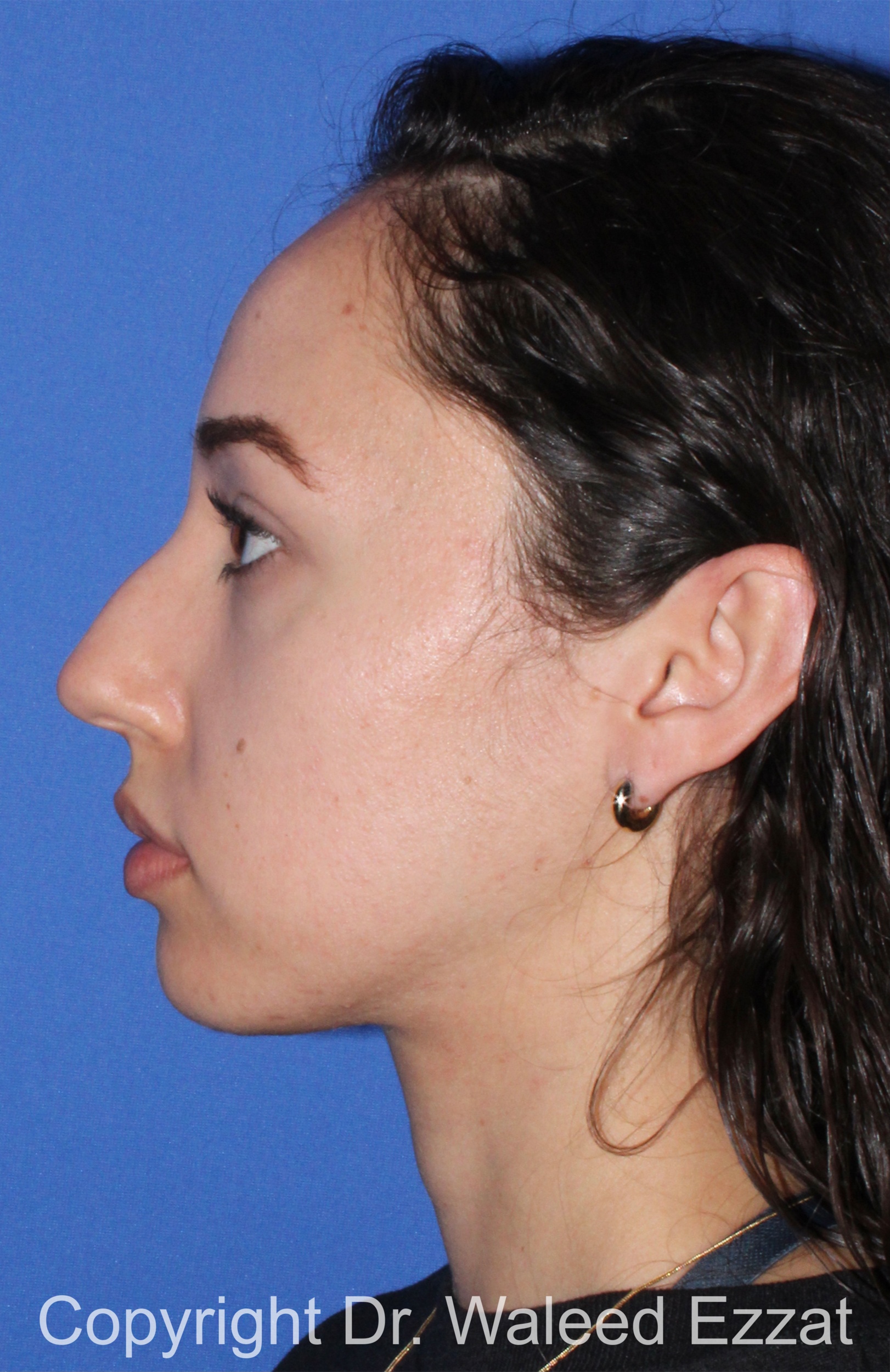 Caucasian/European Rhinoplasty Patient Photo - Case 335 - before view-