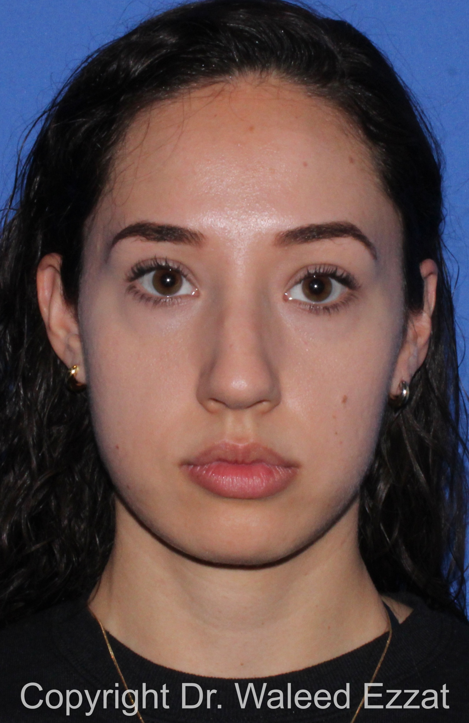 Caucasian/European Rhinoplasty Patient Photo - Case 335 - before view-2