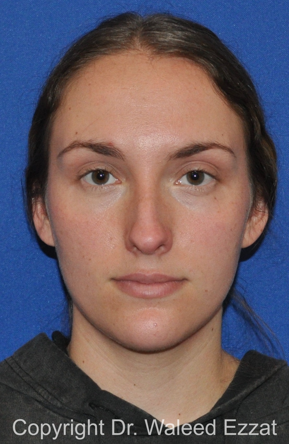 Caucasian/European Rhinoplasty Patient Photo - Case 336 - before view-2