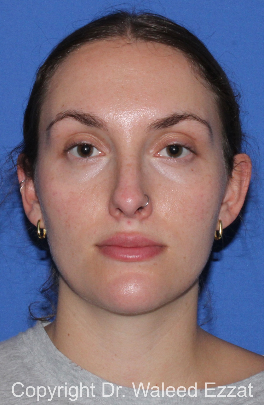 Caucasian/European Rhinoplasty Patient Photo - Case 336 - after view-2
